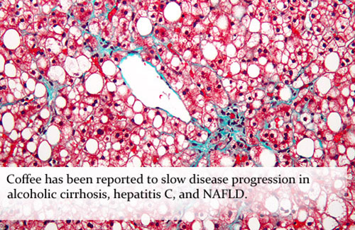 Кофе обладает способностью замедлять развитие алкогольного цирроза, гепатита С и неалкогольной жировой дистрофии печени